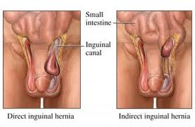 Umbilical hernia - Dr.Χ.Σπυρόπουλος